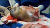 Fascinating Footage of Brazilian Baby Born Still in Amniotic Sac Goes Viral