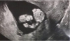 12-Week Unborn Baby “Salutes” Marine Dad in Amazing Ultrasound Image