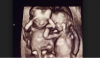 Woman Who Aborted Twins Says She Felt Them Resist: “I Felt Them Moving, I Felt Them Fighting”