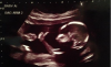 Amazing New Research Shows Unborn Baby’s Heart Begins to Beat at 16 Days