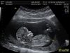 ACLU Files Suit as Kentucky Governor Signs Bill Requiring Ultrasound Prior to Abortion