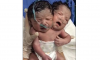 Mother Gives Birth to Conjoined Twins Who Share a Single Body