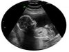 Mother Rejects Abortion After Seeing Baby’s Heartbeat on Ultrasound