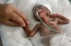 Survival Rates of Premature Babies Born at 23-24 Weeks are Improving