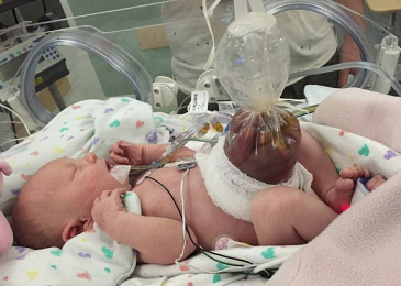 Girl Born “Inside Out” Has Life-Saving Surgery Minutes After Birth. Her Organs Were Outside Her Body