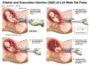 ACLU Fights to Keep Dismemberment Abortions Legal That Tear Off Babies’ Limbs