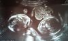 Parents Reject Abortion After Ultrasound Shows Identical Twins Cuddling Each Other