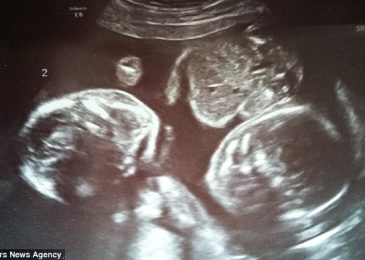 Parents Reject Abortion After Ultrasound Shows Identical Twins Cuddling Each Other
